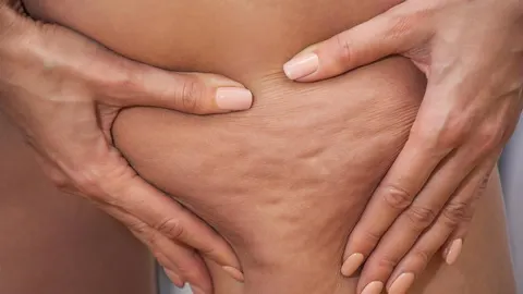 Kрупni plan kože s celulitisom koju prstima steže ženska ruka