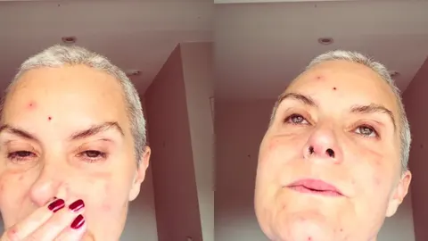 Krupni plan lica glumice Tracy Shaw s vidljivim crvenilom i iritacijama na koži