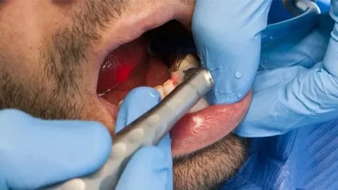 Stomatološki zahvat u ustima pacijenta uz korištenje lasera i zaštitnih rukavica.