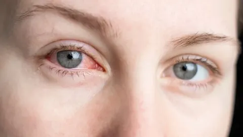 Krupni plan ženskih očiju s vidljivim crvenilom i upalom mrežnice.