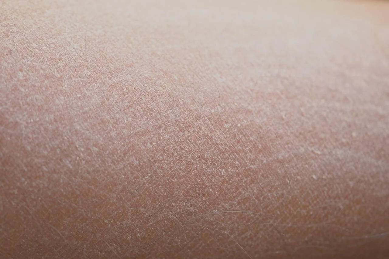 Krupni plan ekstremno suhe i ispucale ljudske kože.