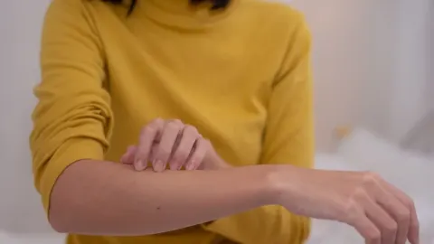 Žena u žutoj majici češe kožu na podlaktici zbog iritacije.