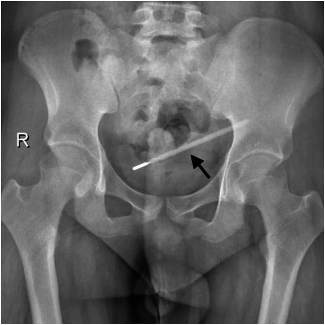 Rendgenska snimka zdjelice prikazuje duguljasti strani predmet označen crnom strelicom.