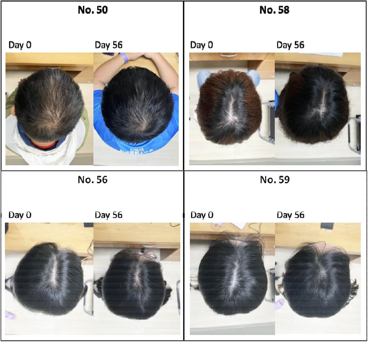 Prikaz rezultata rasta kose kod četiri ispitanika u razmaku od 56 dana.