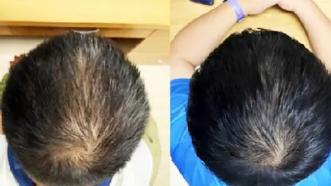 Usporedba tjemena prije i nakon korištenja biljnog seruma za gustoću kose.