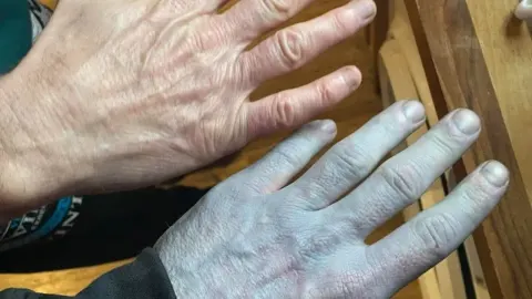 Usporedba dvije muške ruke od kojih je jedna normalne boje, a druga tamnoplava.